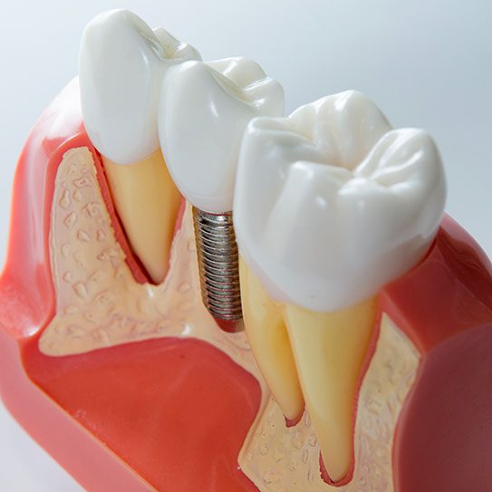 dental implants dentist near me